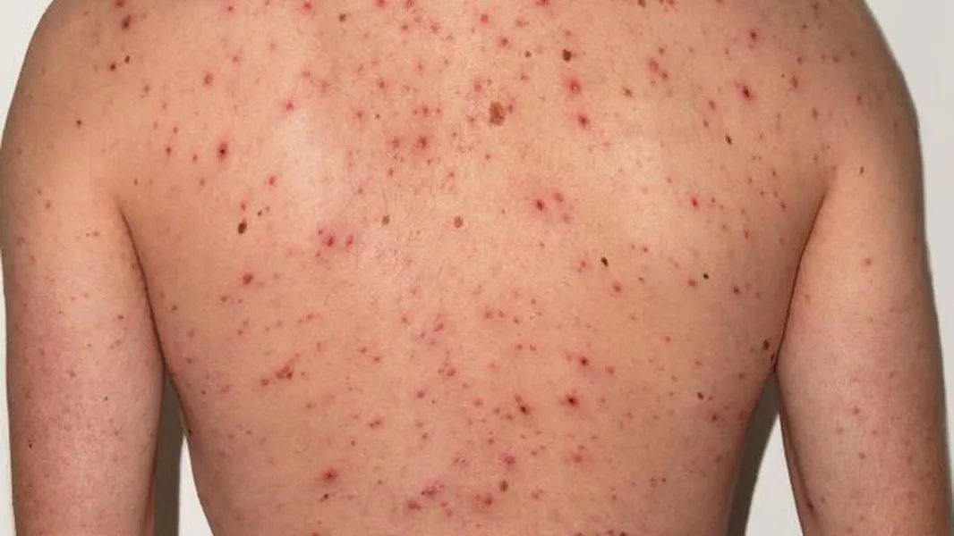 92367-el-ministerio-de-salud-informa-que-se-detecto-un-caso-probable-de-sarampion